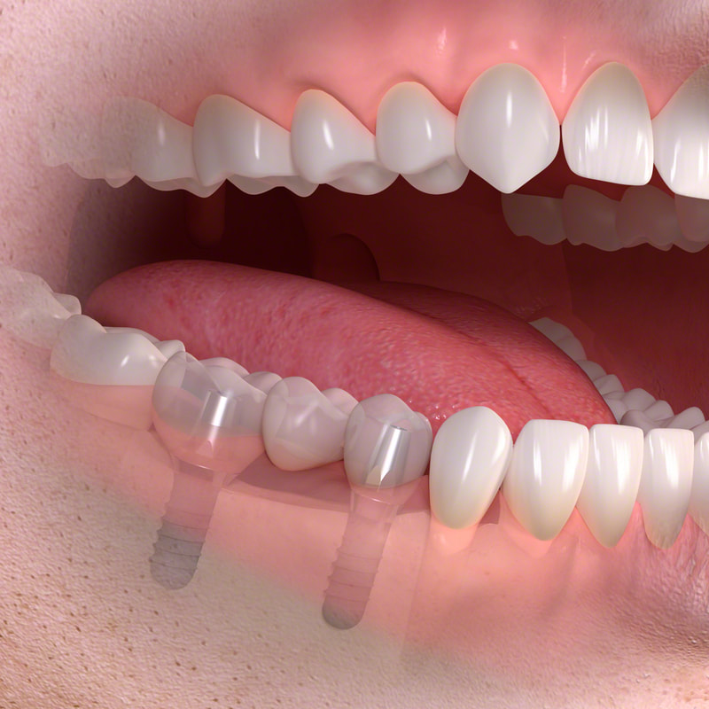 dental implants replaced teeth