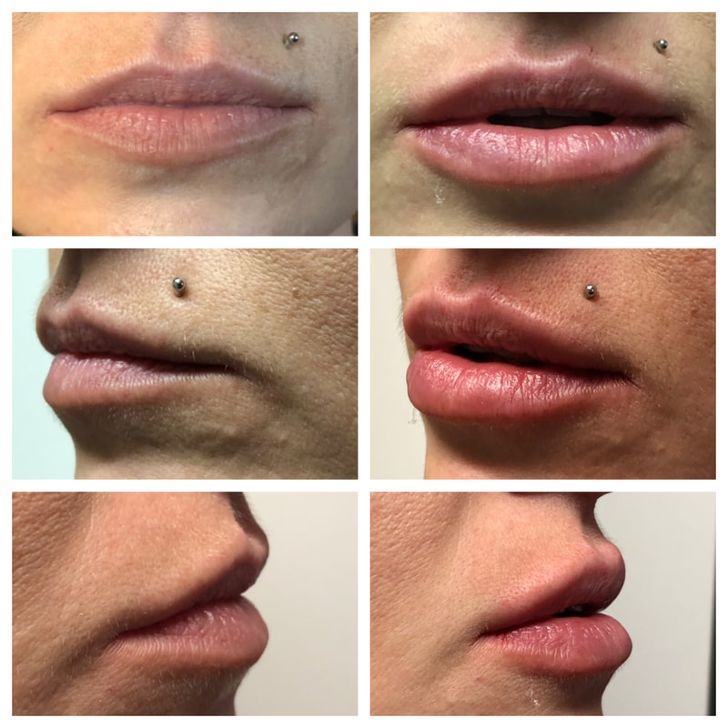 lip filler before after