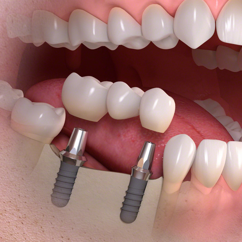 dental implants and bridge