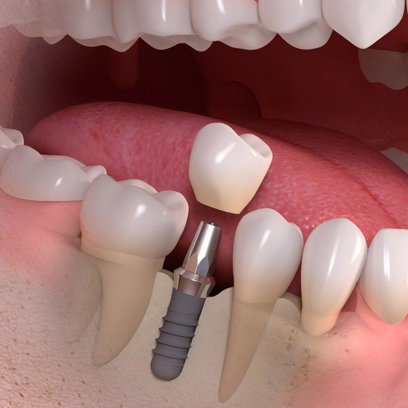 dental implant and crown