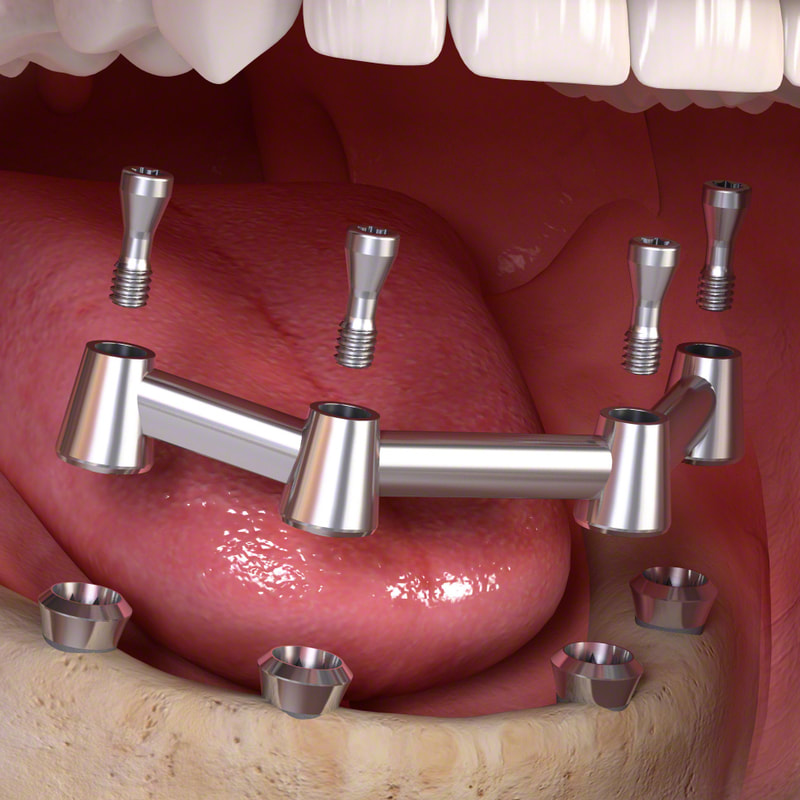 4 dental implants and bar