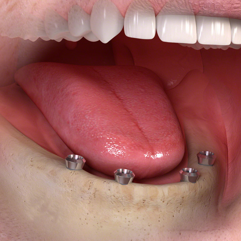 4 dental implants